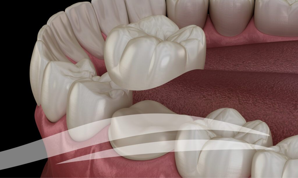 Advantages of same day restorations.