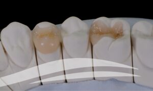 Inlays and onlays for tooth restoration.